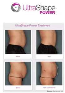 Fat Reduction Skin Tightening Toning