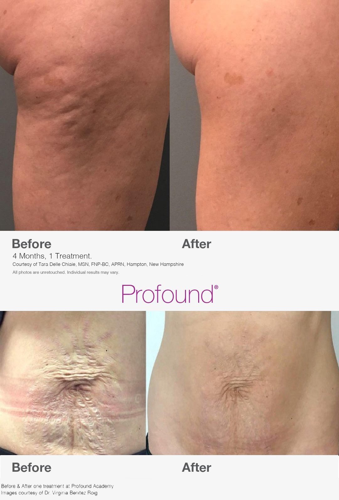 Profound Abdomen & Thigh