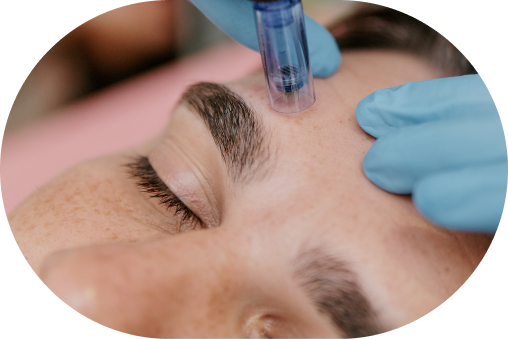 micro-needling-border