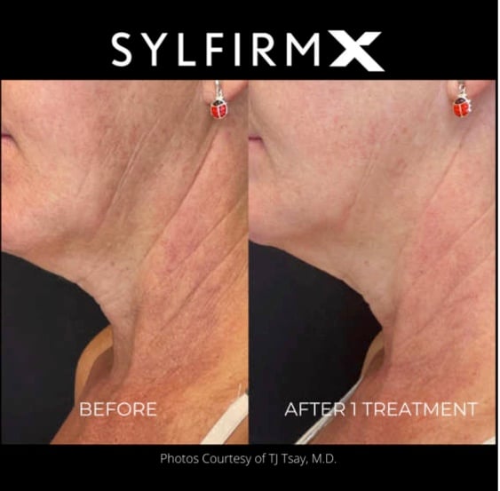 sylfirm-x-1