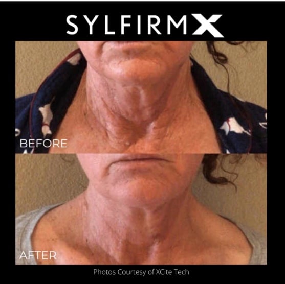 sylfirm-x-4