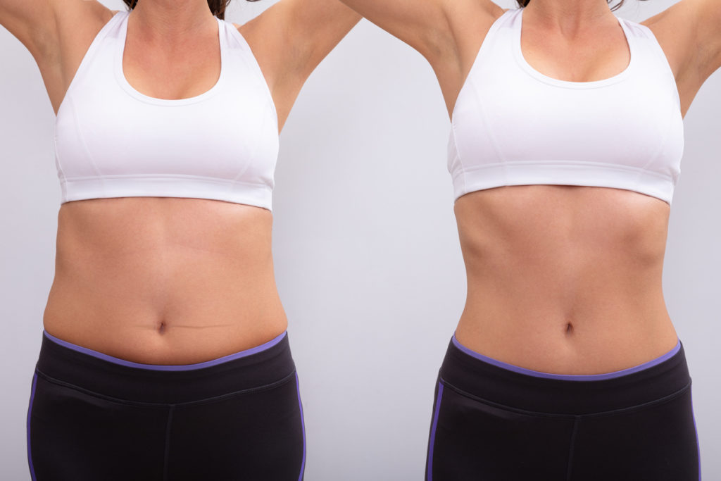 Fat Reduction, Skin Tightening & Toning