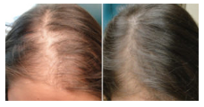 prp-hair-restoration