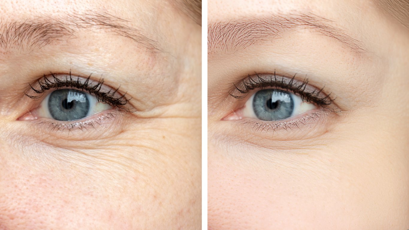 How to Get Rid of Sunken Eyes, Hollow Eyes & Dark Circles | Sunken Under  Eyes | The Cosmetic Skin Clinic