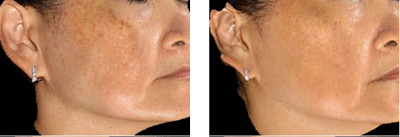 sylfirm-x-before-after-6-treatments
